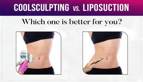 Laser Liposuction: A Safe and Efficient Solution for Fat Sculpting
