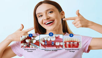 How Much Do Dental Implants Cost?