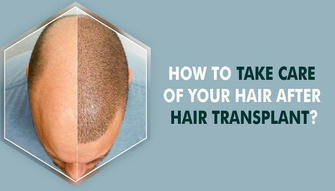 Post-Transplant Hair Care: Essential Tips for Long-Lasting Results