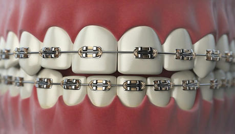 A Simple Guide to Dental Care and Braces: Benefits and Tips